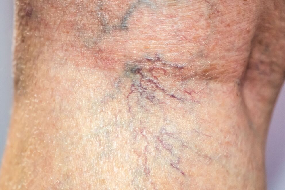 vene varicose sul corpo