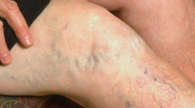 Sintomi visibili di vene varicose sulle gambe