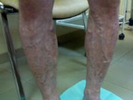 Vene varicose sulle gambe