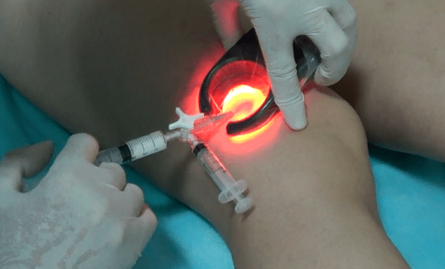 La scleroterapia è un metodo efficace per trattare le vene varicose sulle gambe