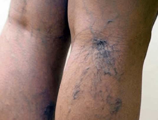 vene varicose sulle gambe