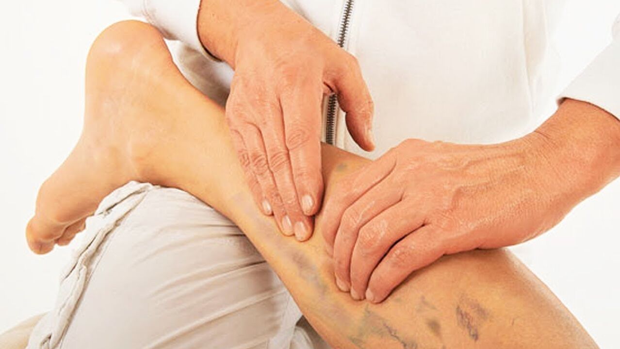 trattamento delle vene varicose con gel Vetonus
